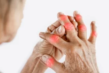 A rheumatoid arthritis nem csak az ízületekben okozhat problémát